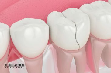 ترمیم دندان شکسته | روش ها و مراحل درمان