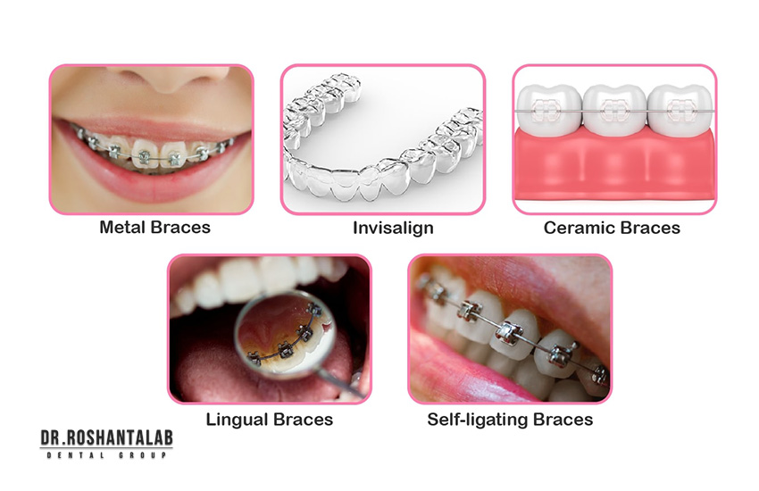 انواع ارتودنسی نامرئی