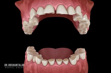 ایمپلنت در افرادی که دندان قروچه دارند