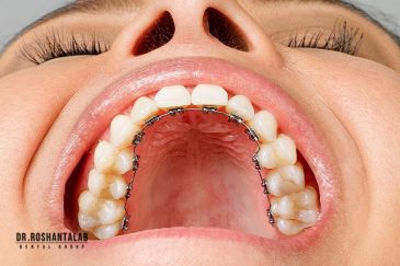 ارتودنسی لینگوال