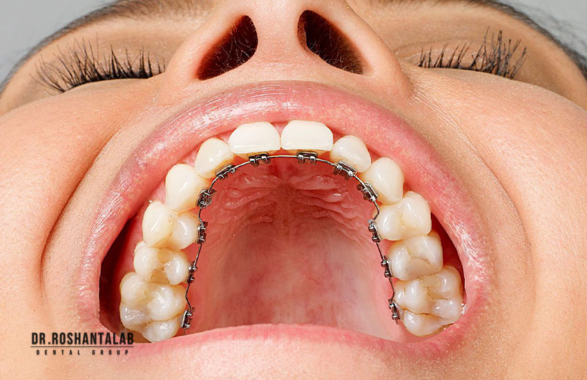 ارتودنسی لینگوال