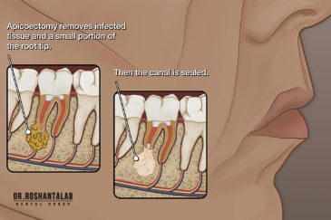 جراحی ریشه دندان یا اپیکواکتومی
