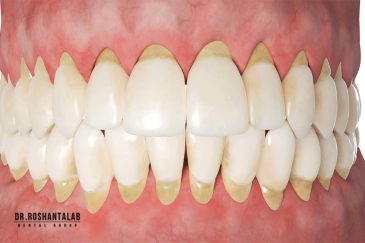 علت تحلیل لثه چیست؟