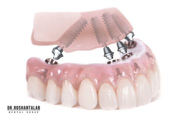 ایمپلنت All On 4 چیست و چه کاربردی دارد؟