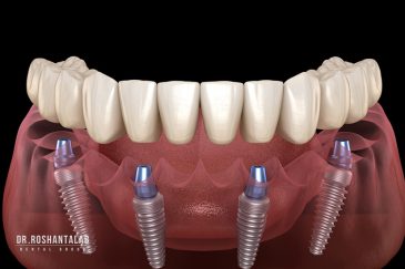 مراقبت های ایمپلنت دندان