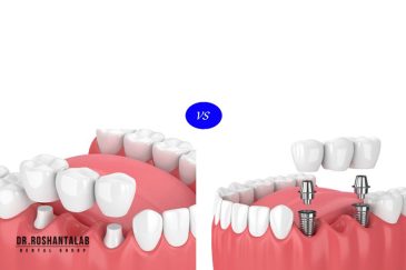 تفاوت روکش و ایمپلنت دندان