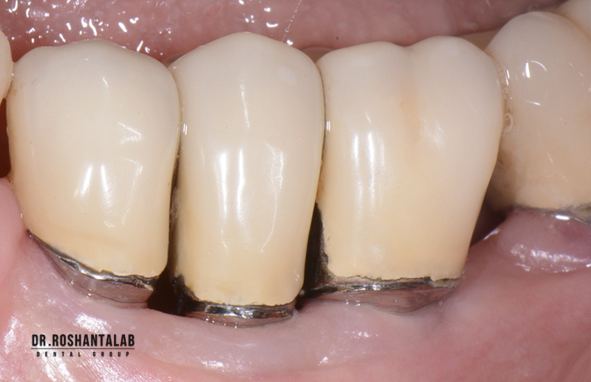 التهاب اطراف ایمپلنت (پریایمپلنتایت)