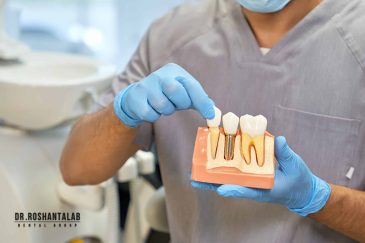 آیا ایمپلنت دندان دچار پوسیدگی می شود؟