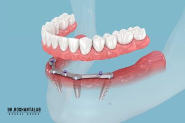 بهترین کلینیک ایمپلنت رشت (دکتر روشن طلب)