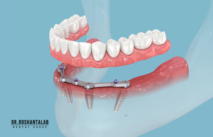 بهترین کلینیک ایمپلنت رشت (دکتر روشن طلب)