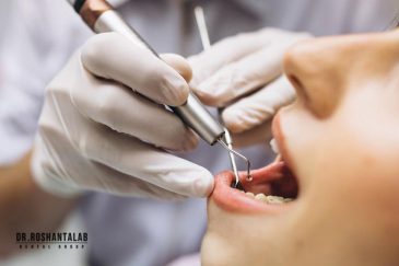 عصب کشی ناقص دندان