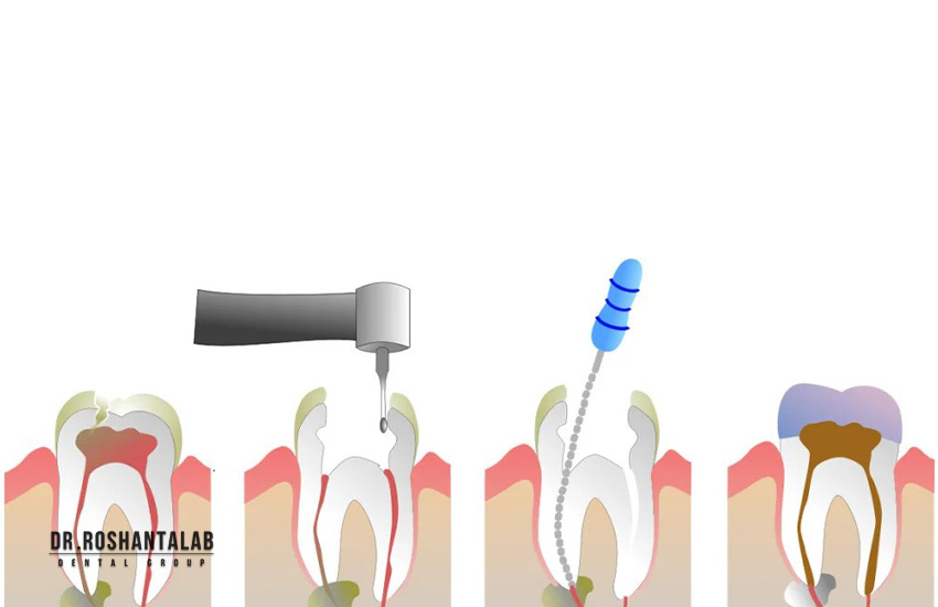 عصب کشی ناقص دندان و عوارض آن چیست؟ - کلینیک تخصصی ایمپلنت رشت - خبرخوان تی شین