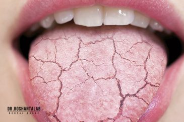 خشکی دهان ناشی از دندان مصنوعی