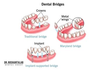 انواع بریج های دندانی