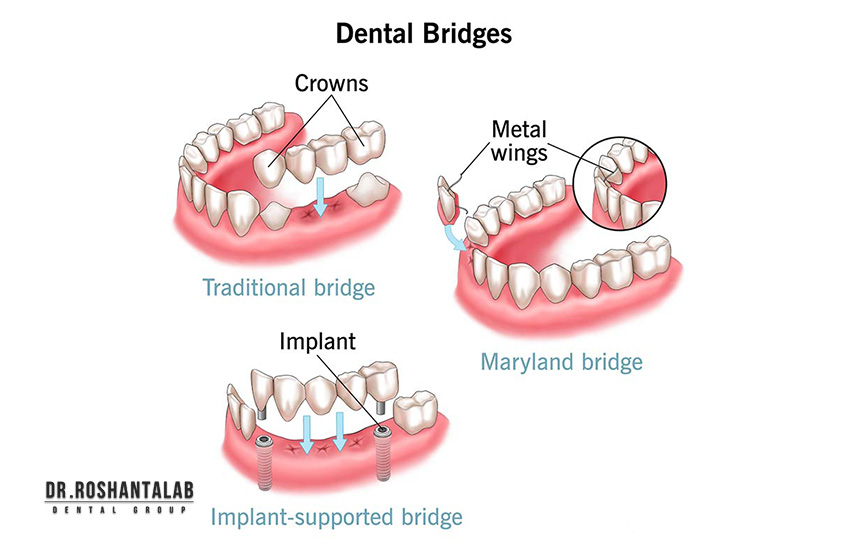 مزایا و معایب بریج دندان چیست؟ - کلینیک تخصصی ایمپلنت رشت - خبرخوان تی شین