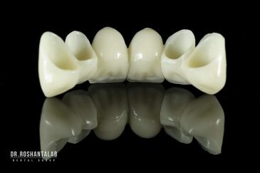 مزایا و معایب بریج دندان چیست؟