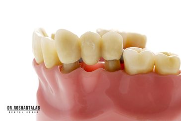 طول عمر بریج دندان چقدر است؟