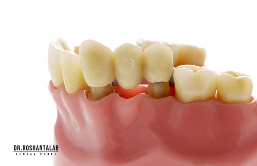 طول عمر بریج دندان چقدر است؟