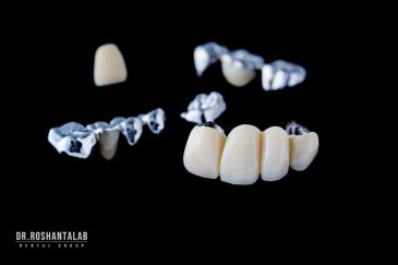 مشکلات رایج بریج دندان