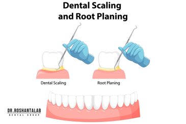 فرق جرم گیری لثه با جرم گیری دندان