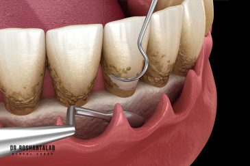 جرم‌گیری پریودنتال یا پلانینگ ریشه