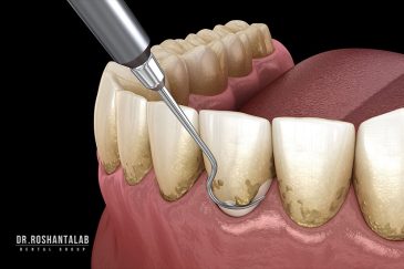 مراقبت های جرمگیری دندان