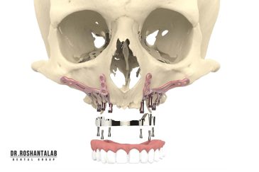 کاشت ایمپلنت ساب پروستئال