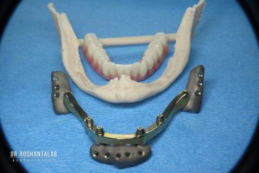 ایمپلنت ساب پریوستئال