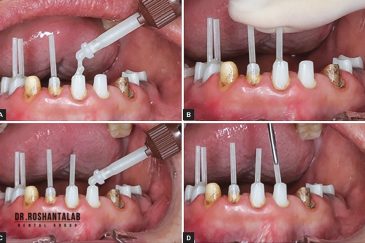 پست و کور جهت حفظ دندان