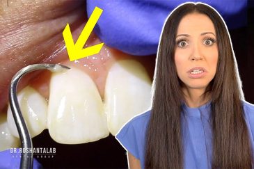 آیا جرم گیری به دندانها آسیب میزند؟