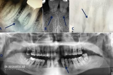 تحلیل ریشه دندان، از علت تا درمان