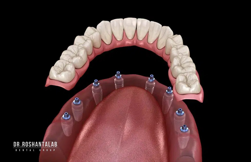 All on 8 ایمپلنت کامل دندان