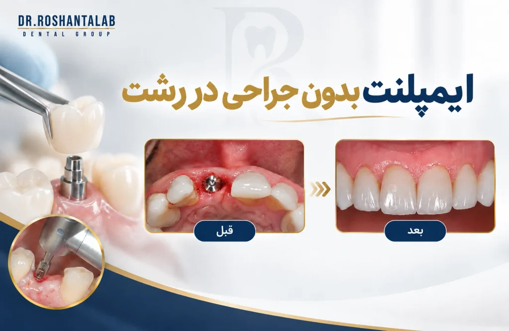 آیا ایمپلنت بدون درد همان ایمپلنت بدون جراحی است؟
