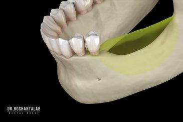 تحلیل لثه بعد از کشیدن دندان