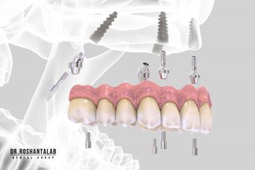 قیمت ایمپلنت All On 4: مراحل کاشت، برای چه افرادی مناسب است؟