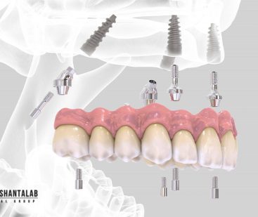 قیمت ایمپلنت All On 4: مراحل کاشت، برای چه افرادی مناسب است؟