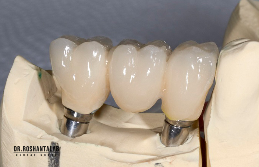 روکش دائم ایمپلنت