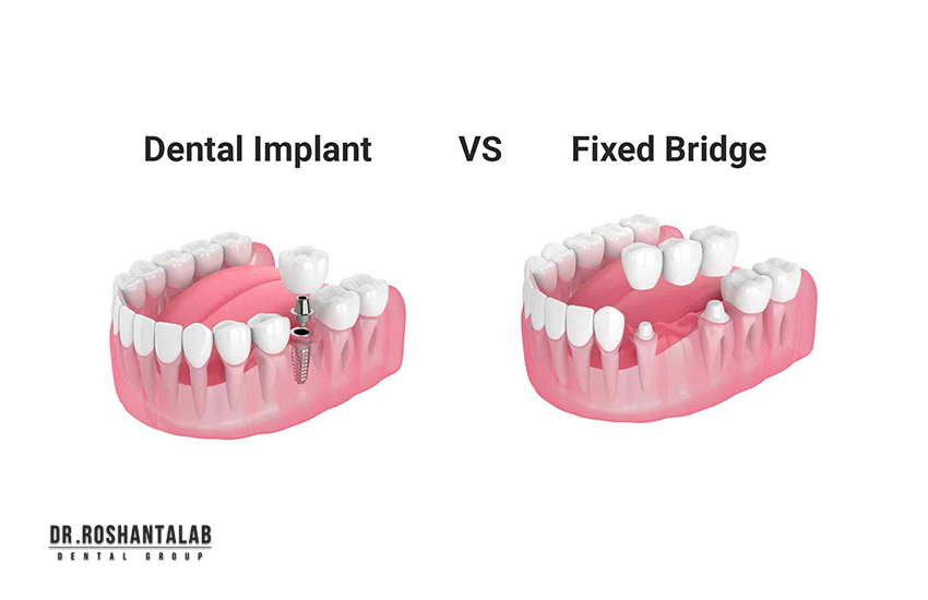 کاشت ایمپلنت دندان بهتر از روکش بریج