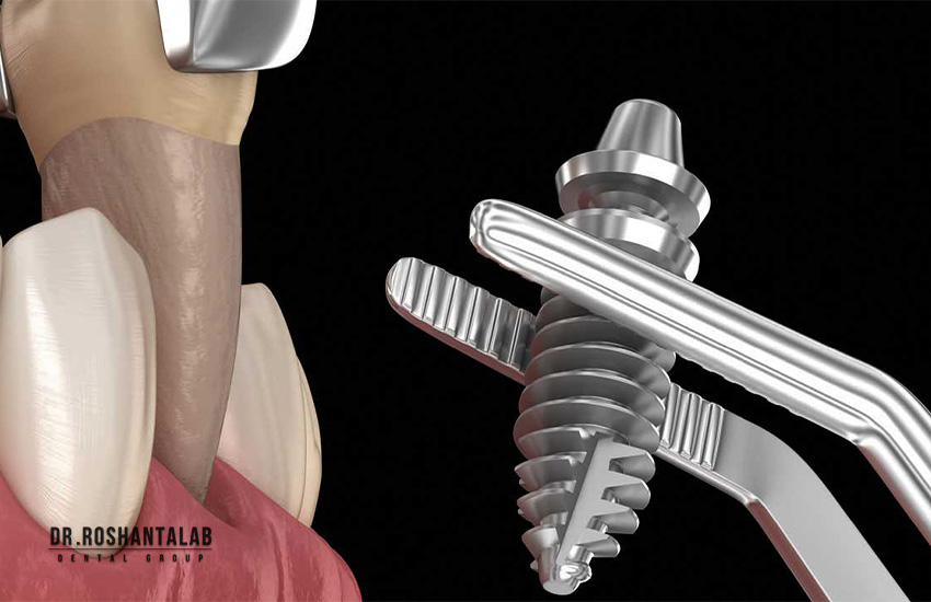 کشیدن و کاشت ایمپلنت فوری
