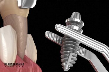 مدت زمان ایمپلنت فوری : 5 حقیقت پنهان که باید بدانید!