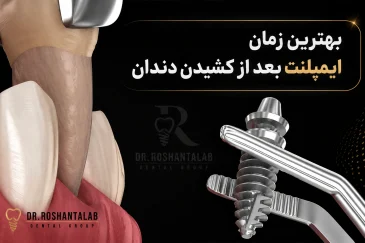 بهترین زمان ایمپلنت بعد از کشیدن دندان