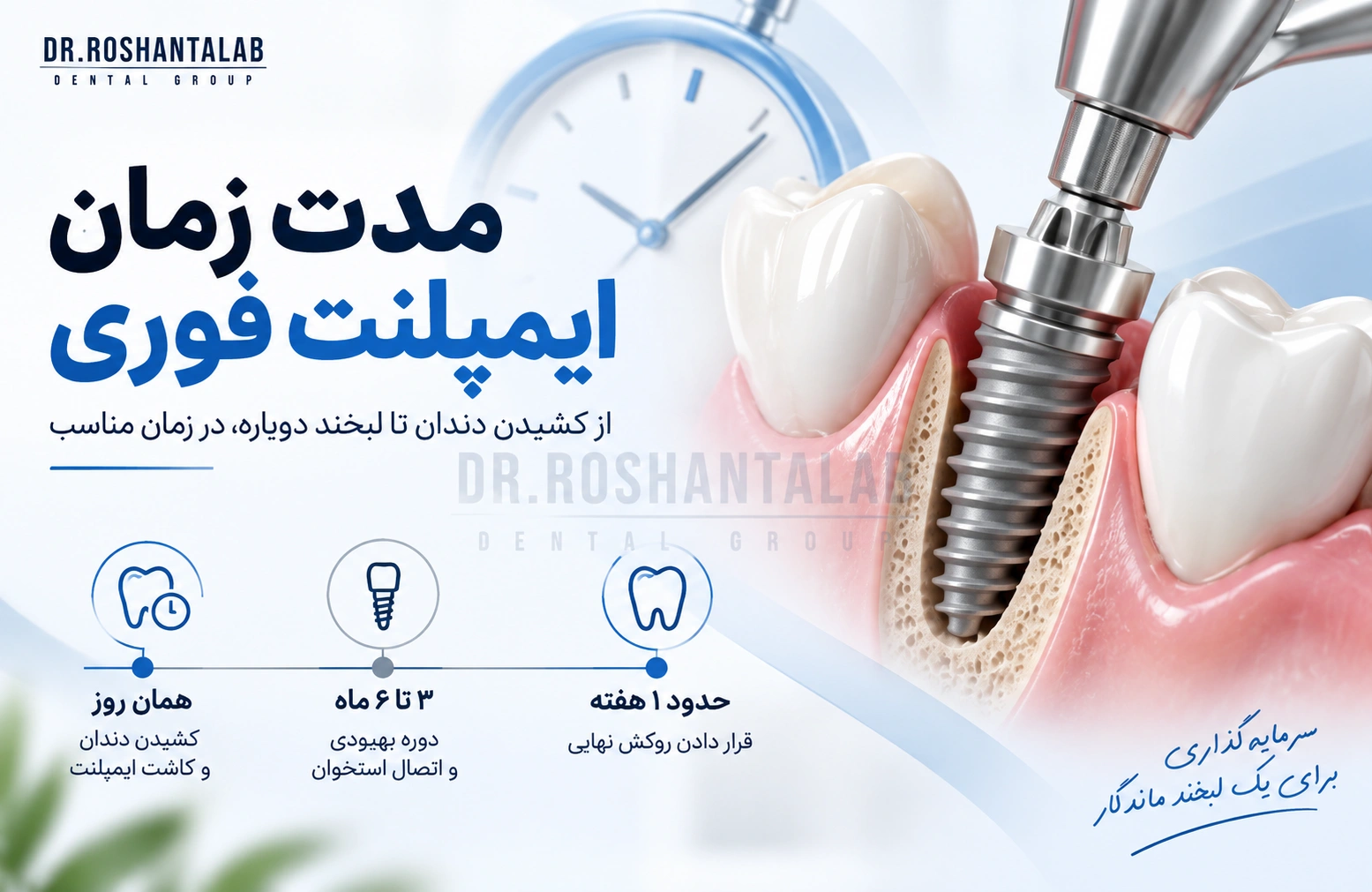 مدت زمان ایمپلنت فوری؛ 7 مرحله از جراحی تا روکش نهایی