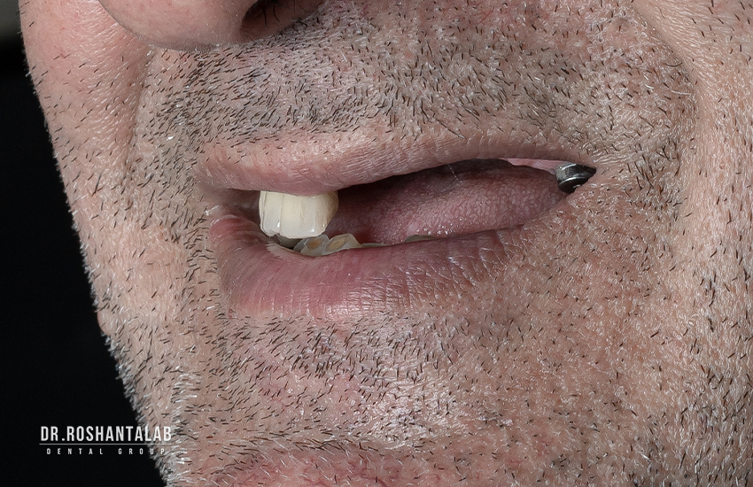 کاشت ایمپلنت دندان برای بیمار در کلینیک دکتر روشن طلب