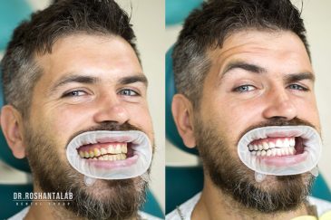 آیا بلیچینگ به مینای دندان آسیب می زند؟