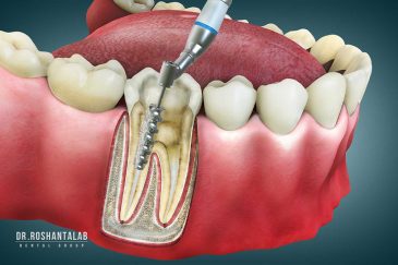 عصب کشی مجدد