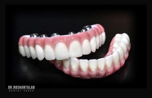 روکش‌ های ایمپلنت چسبی یا پیچ‌ شونده : کدام بهتر است؟