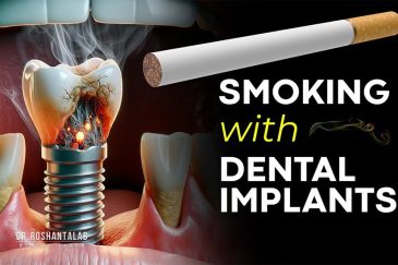 ایمپلنت دندان در افراد سیگاری