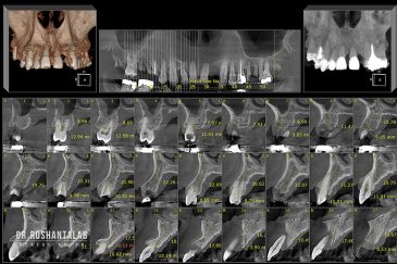 CBCT