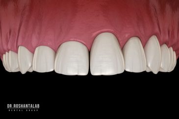 لیفت لثه و مراقبت های بعد از آن