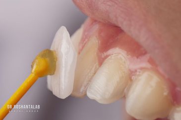 لمینت سرامیکی